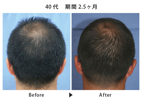 男性の本格育毛・発毛・薄毛治療  ヘアインパクトコース施術例